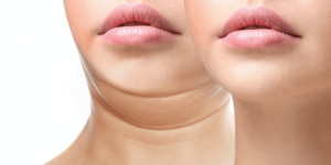 double chin removal woman compare
